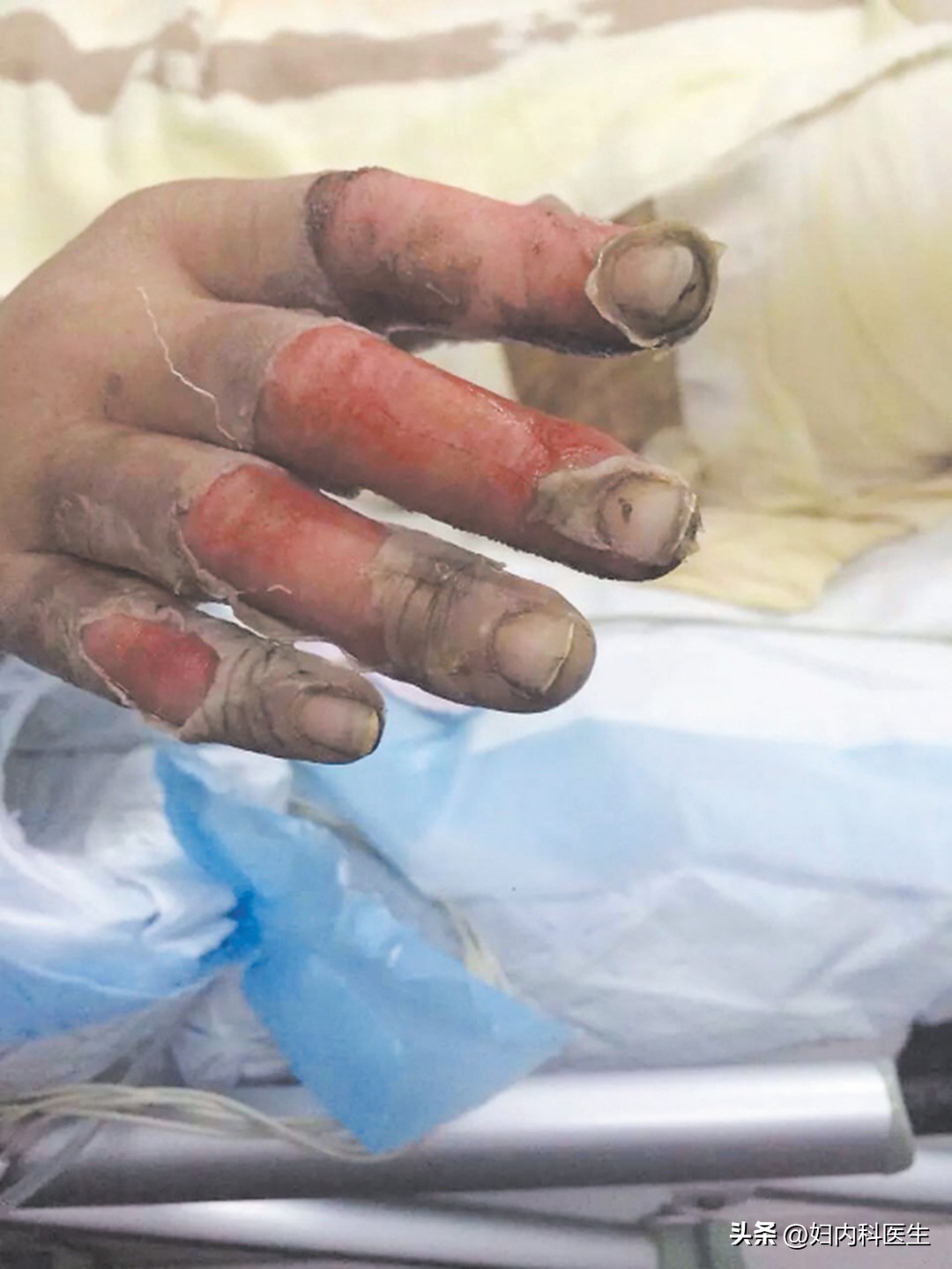 没有传染性的灰指甲,灰指甲没有甲板了怎么治