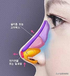 耳软骨隆鼻会被吸收吗,用耳软骨隆鼻还需要加别的材料吗