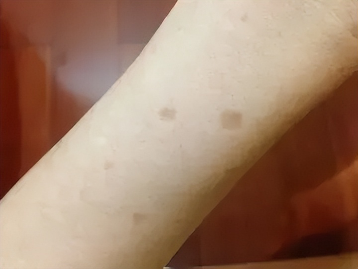 老年斑和色素沉着怎么区分,老年斑和色素沉着怎么治