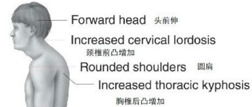 颈复康治疗颈源性头痛吗,颈源性头痛整体解决方案