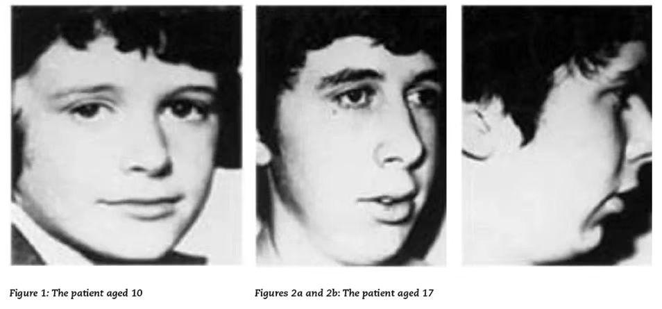 腺样体肥大孩子变丑,腺样体肥大大概几岁开始面貌变丑