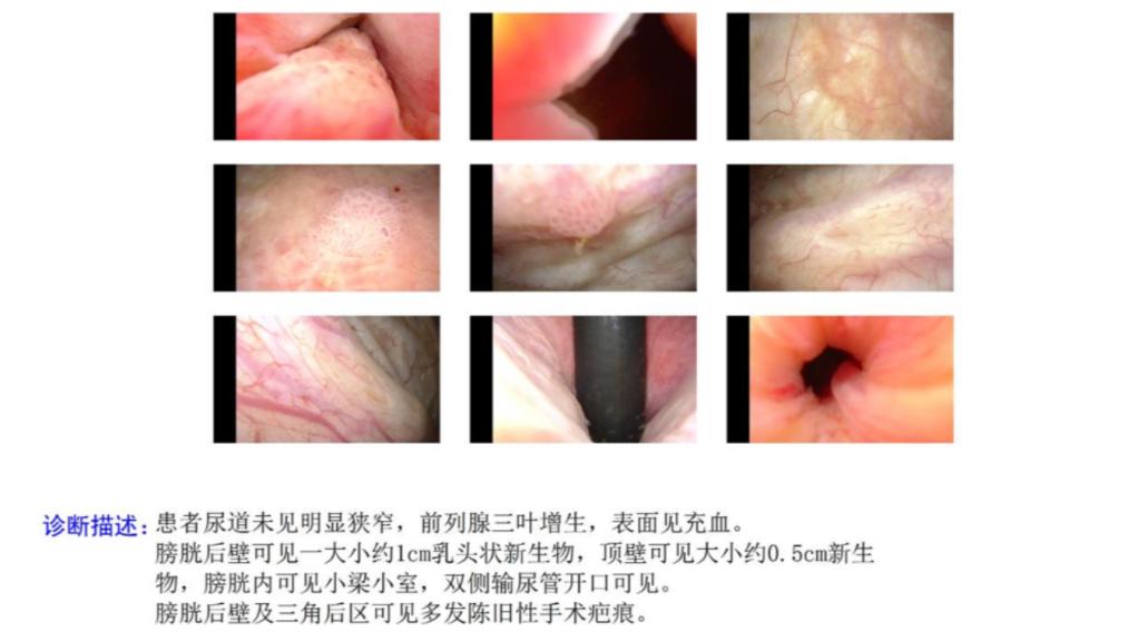 治疗膀胱癌术后必须用卡介苗吗,膀胱癌治愈五年未复发是痊愈了吗