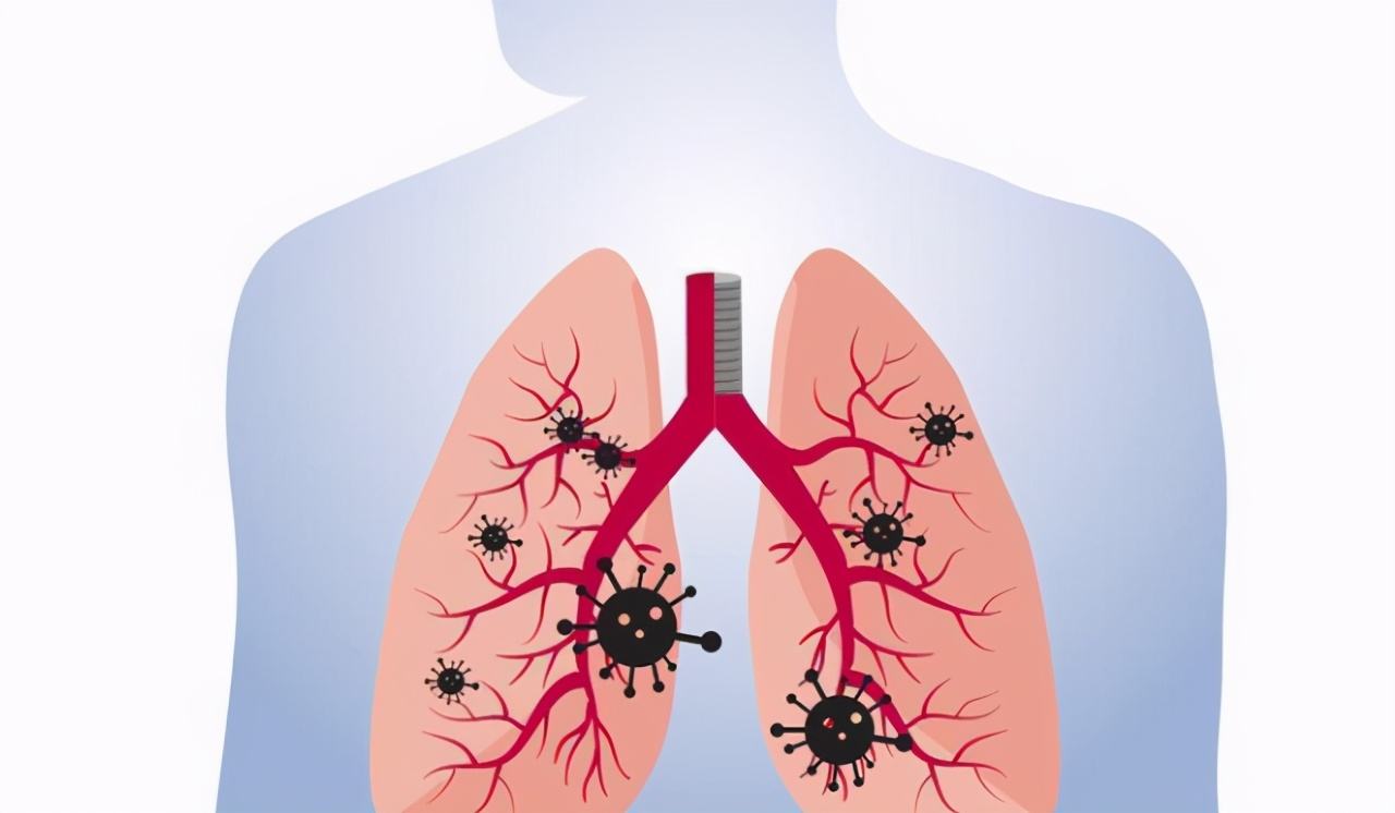 中医对肺结节的辨证治疗,中医对肺结节的认识与治疗