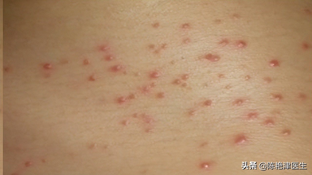 坐骨神经受损吃甲钴胺有用吗,甲钴胺能治疗神经损害吗