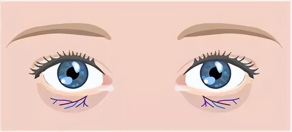 专治黑眼圈的方法,如何自测黑眼圈