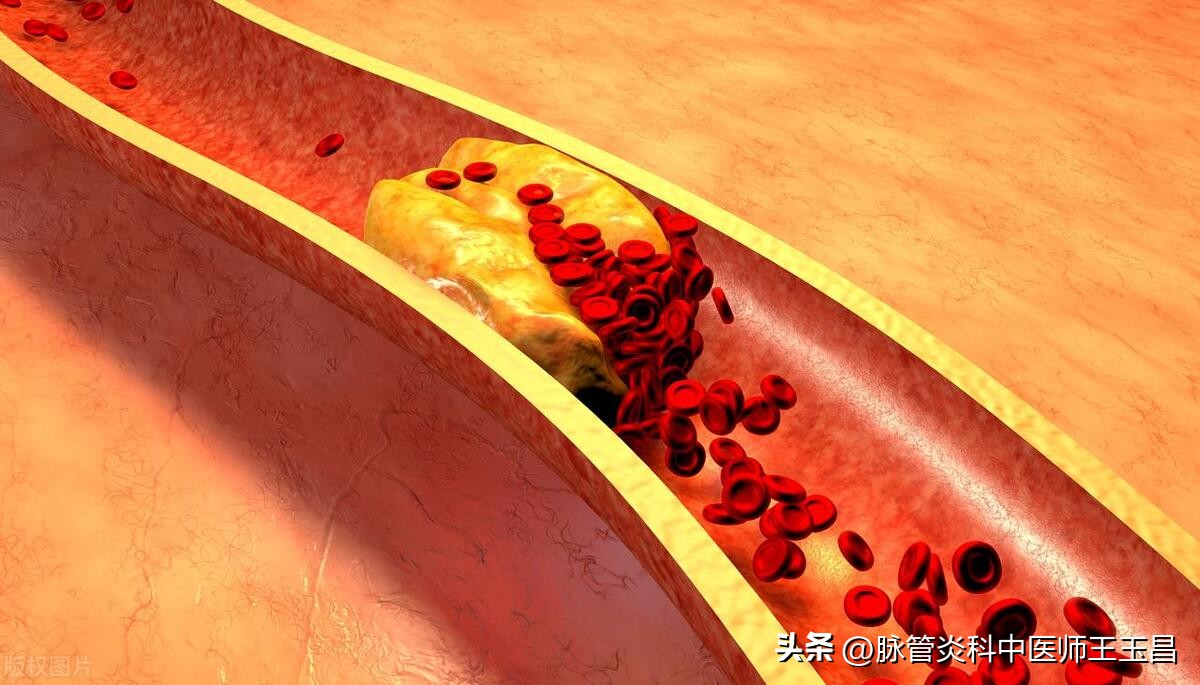 中药治疗下肢动脉硬化闭塞,中医能治疗下肢动脉硬化闭塞症吗