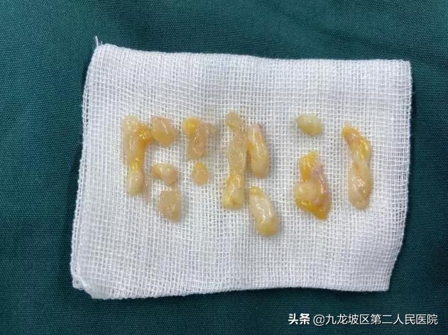 乳腺结节无疤消融术手术记录,乳腺手术不缝合皮下组织多久愈合