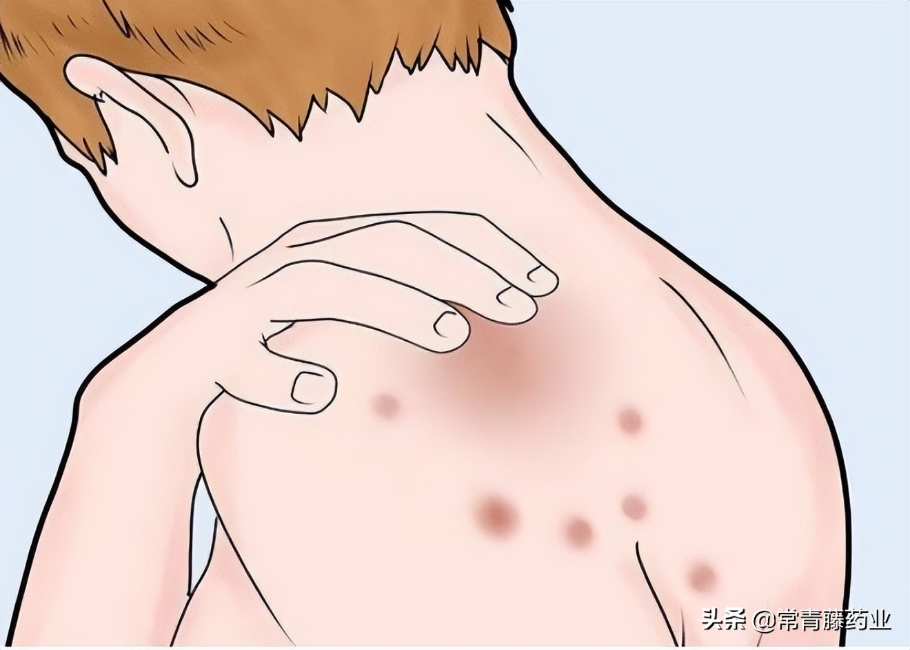 痘痘像蚊子包一样大怎么消,痘痘和蚊子包的黑印怎么消