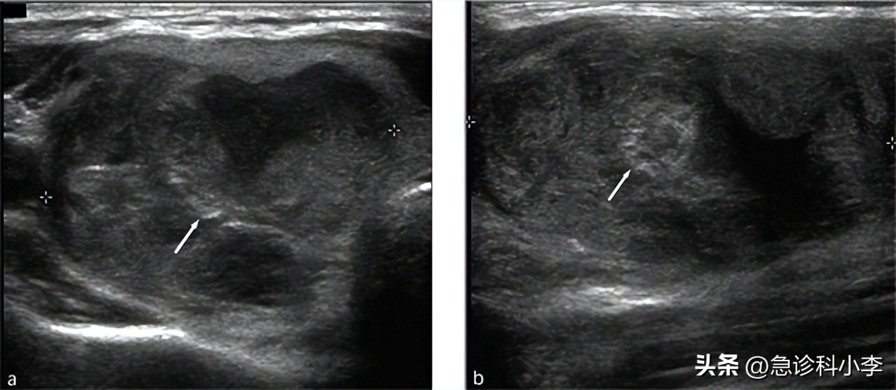 甲状腺实性结节4a癌变几率有多大,长了甲状腺结节癌变的几率有多大