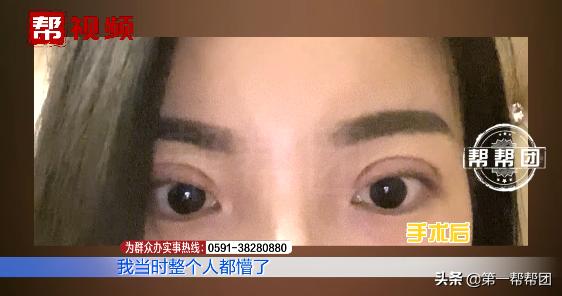 90后割双眼皮亲身经历,割了双眼皮后特后悔