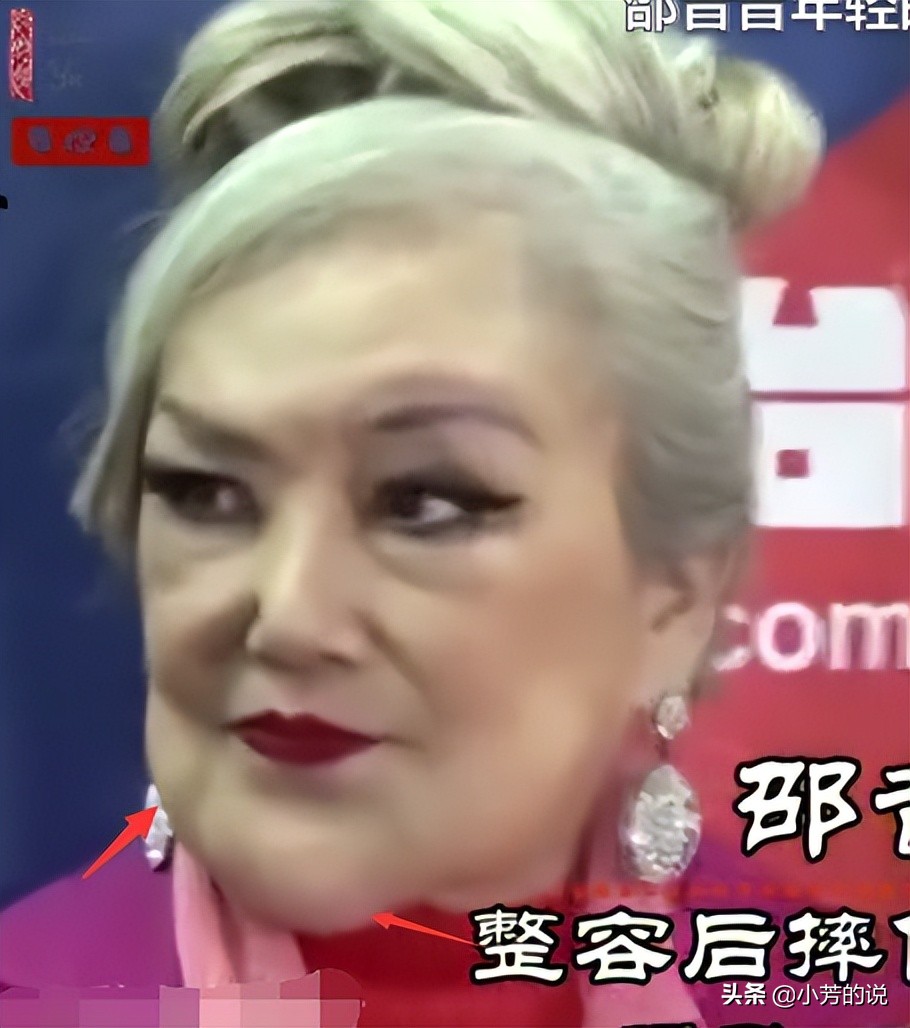 整容后出车祸假体外露,整容了被砸到脸会怎么样