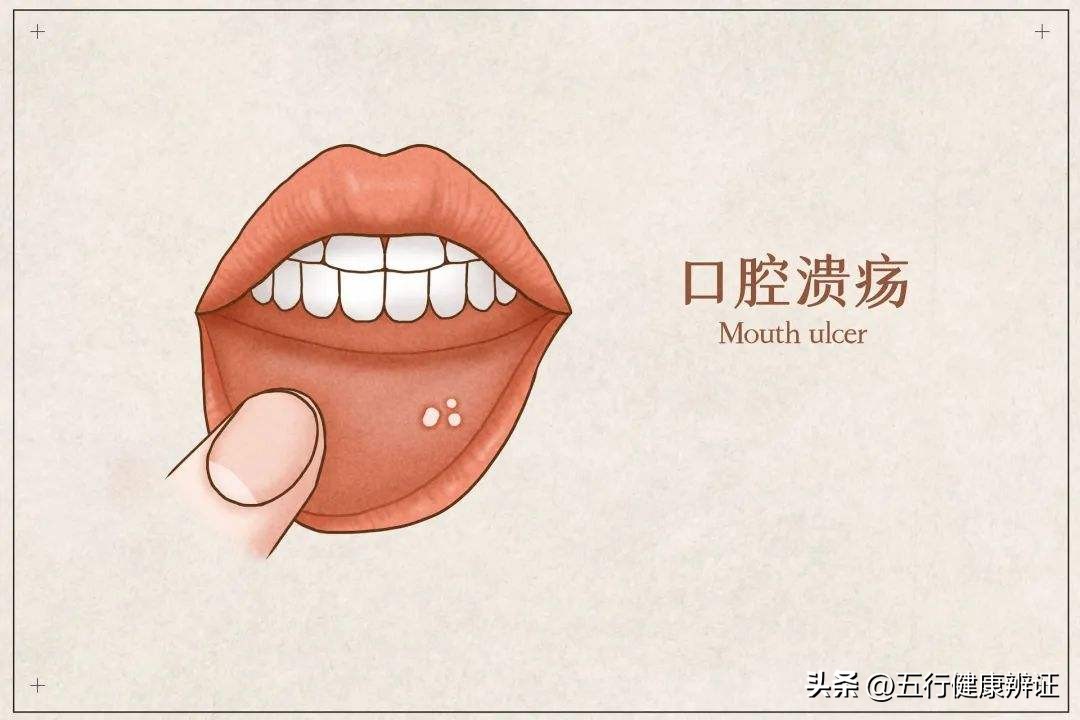 反复发作口腔溃疡吃什么中药,口腔溃疡老是反反复复吃什么中药