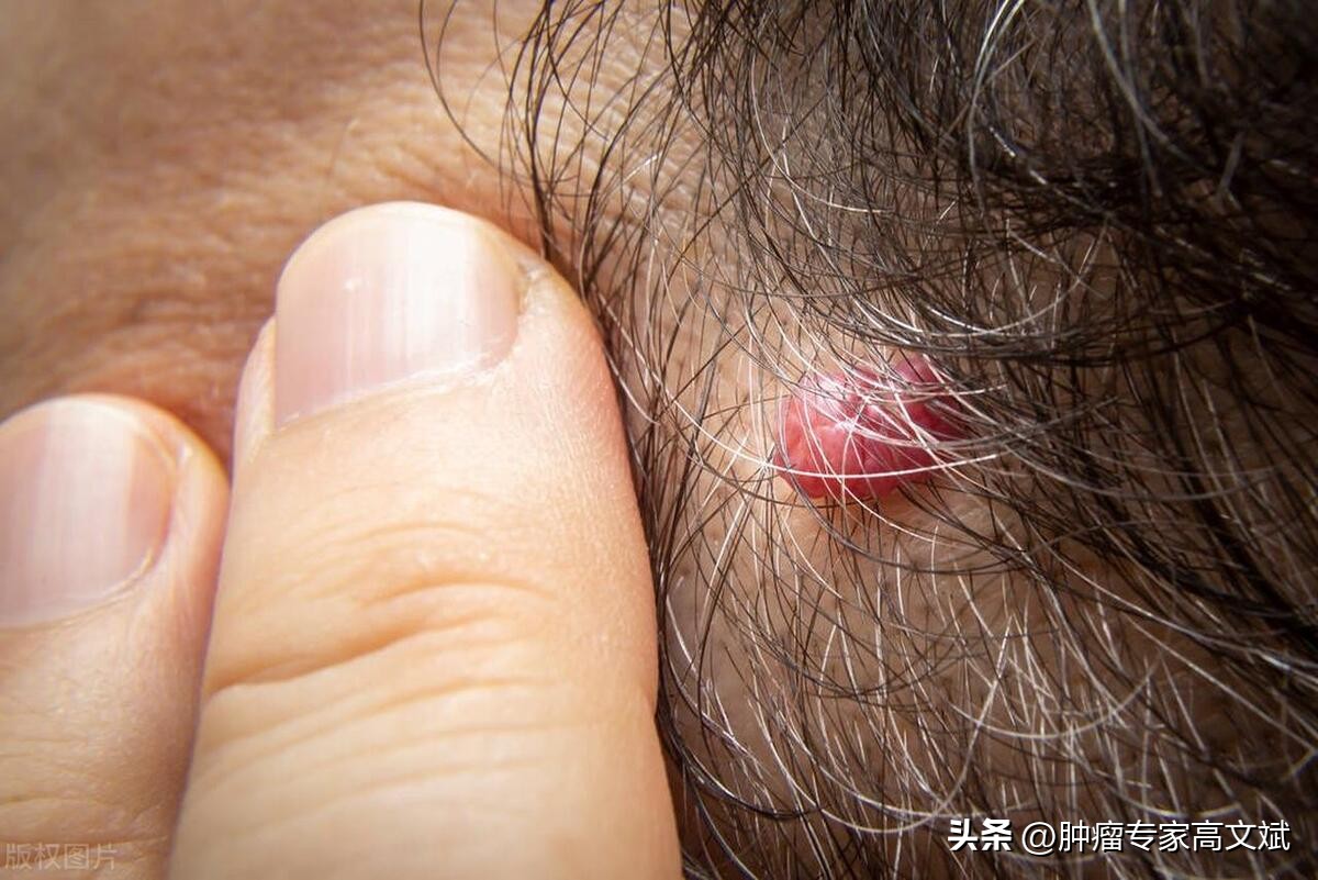 说说你身上的痣,说说你们的痣都是怎么来的