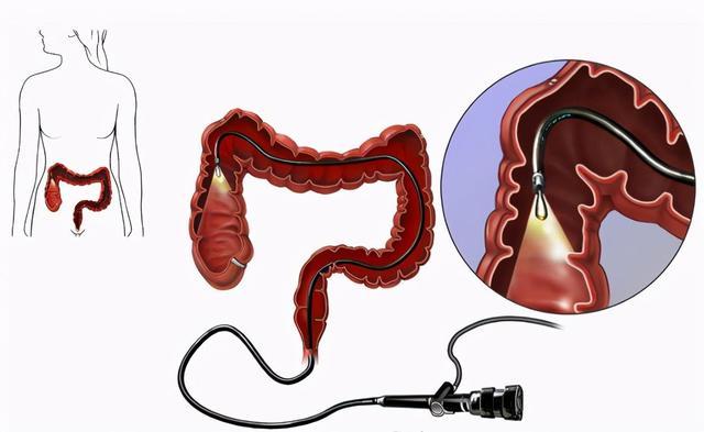 做肠镜尴尬怎么办,男医生给女病人做肠镜合适吗