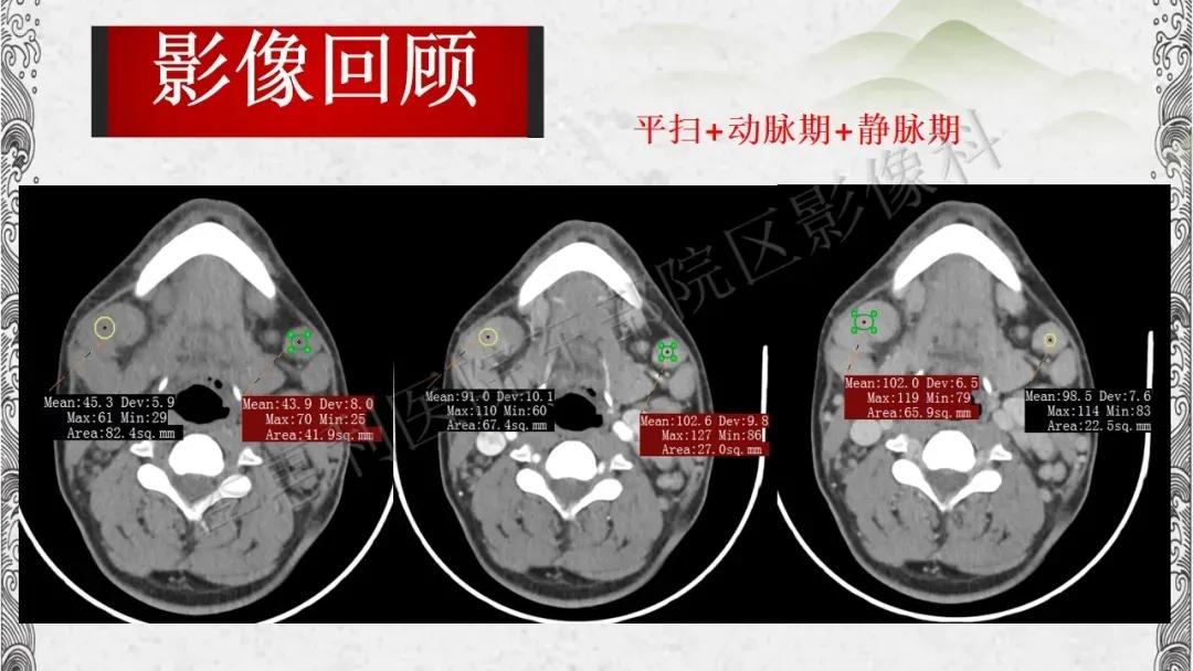 木村病治愈成功案例,木村病诊断案例