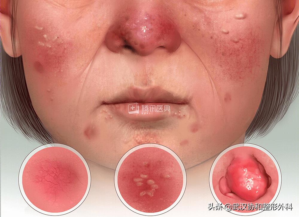 酒糟鼻导致鼻子肥大怎么办,酒糟鼻鼻子变大变厚怎么治疗