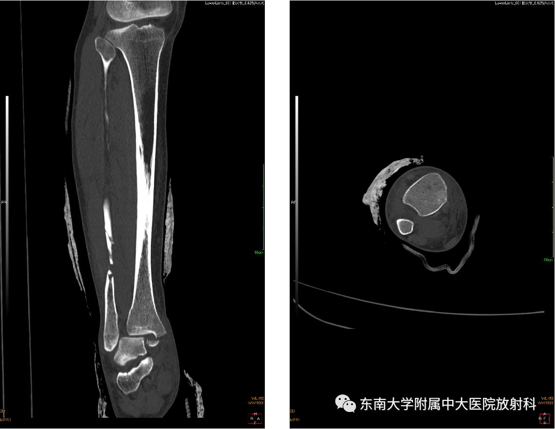 左腓骨下段骨折伴下胫腓联合分离,好文分享深度揭秘