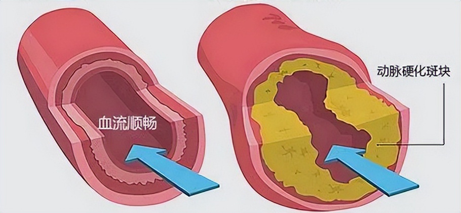 红酒软化血管靠谱吗,软化血管吃哪种鱼油