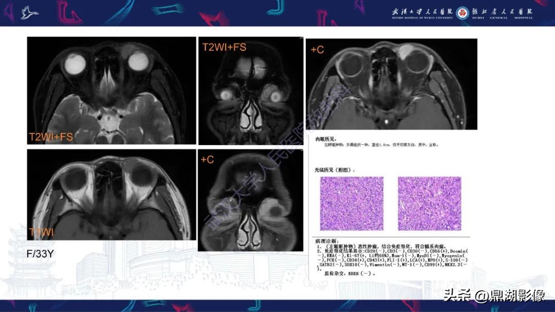 阴道里长肉瘤是啥症状,阴道肉瘤症状