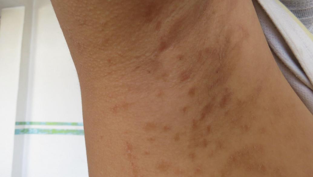 女子腹部痒，医生用镊子夹出16只阴虱！原来阴虱有4个传播途径