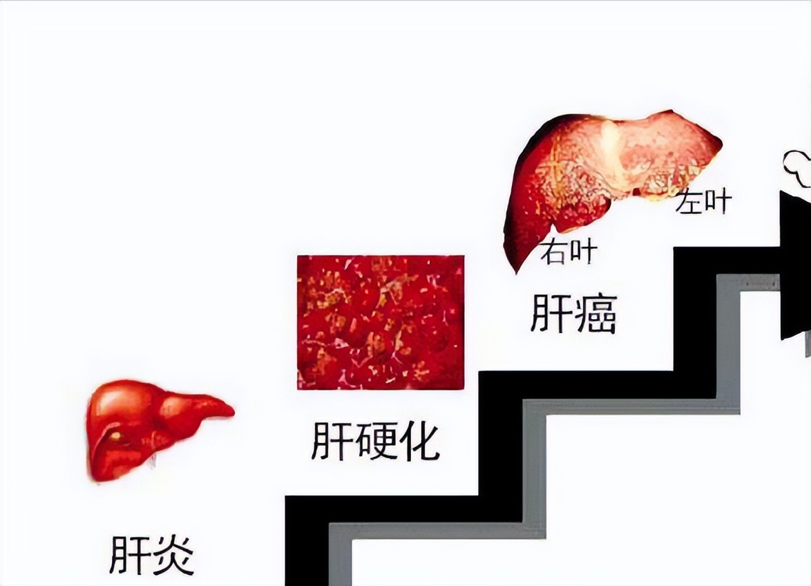 17岁谷丙转氨酶105,18岁男孩转氨酶五百多