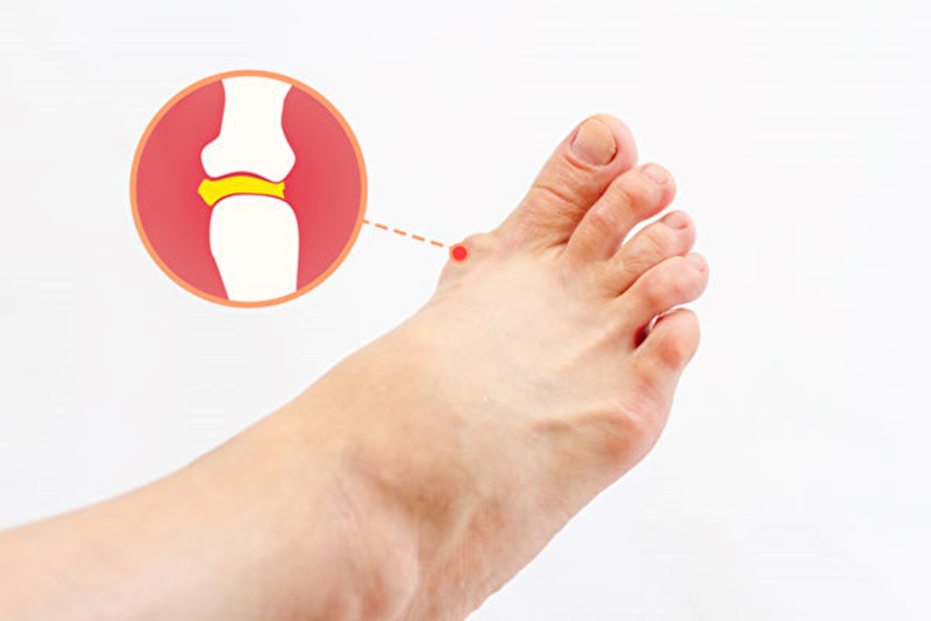 游走性关节痛是什么原因引起的,关节痛有哪些症状会影响到关节痛