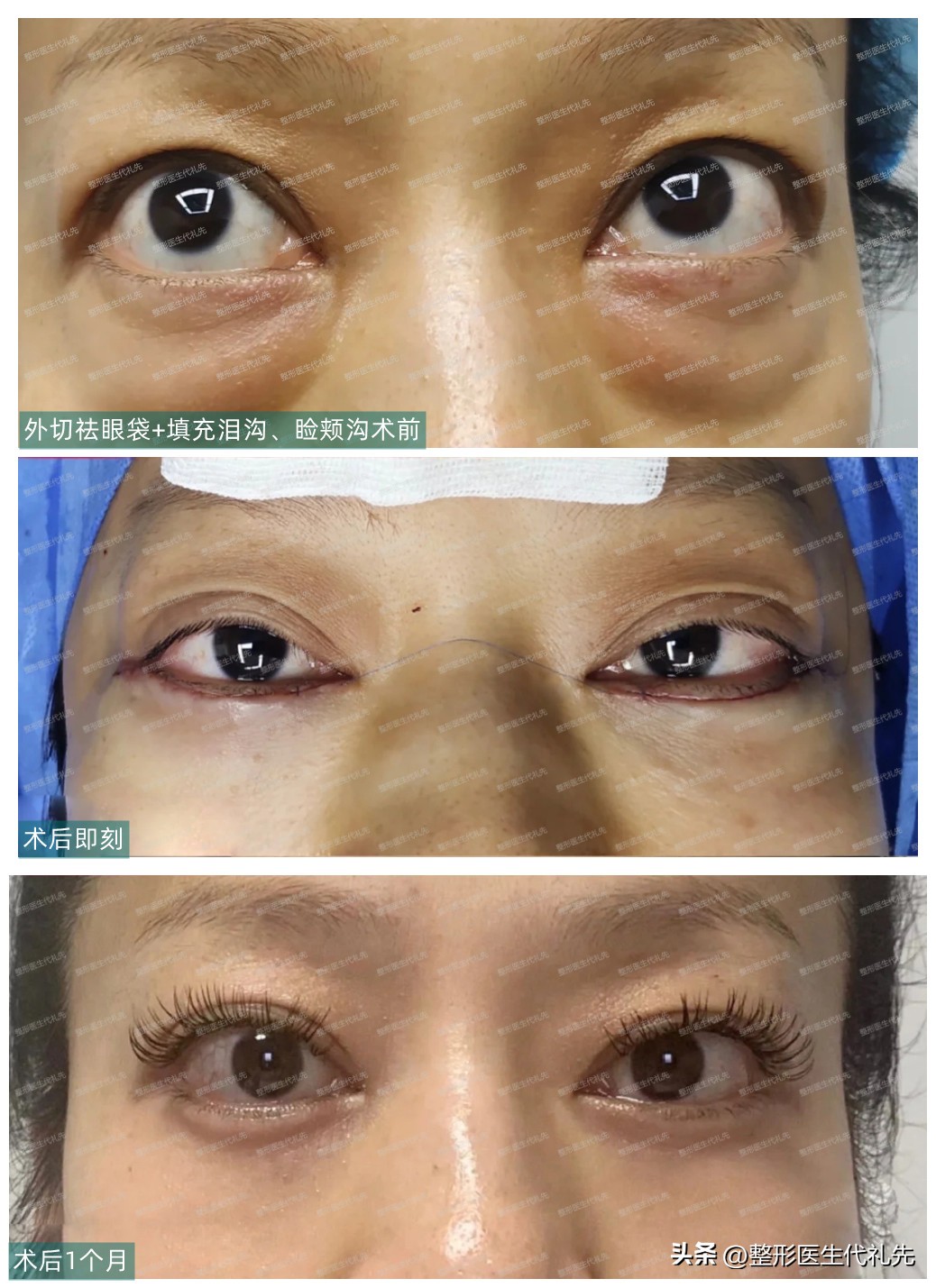 内切祛眼袋手术亲身经历恢复,作为一名整形医生对整形的理解