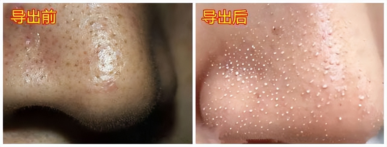 真黑头怎么去,黑头用黑头膏为什么去不掉黑头