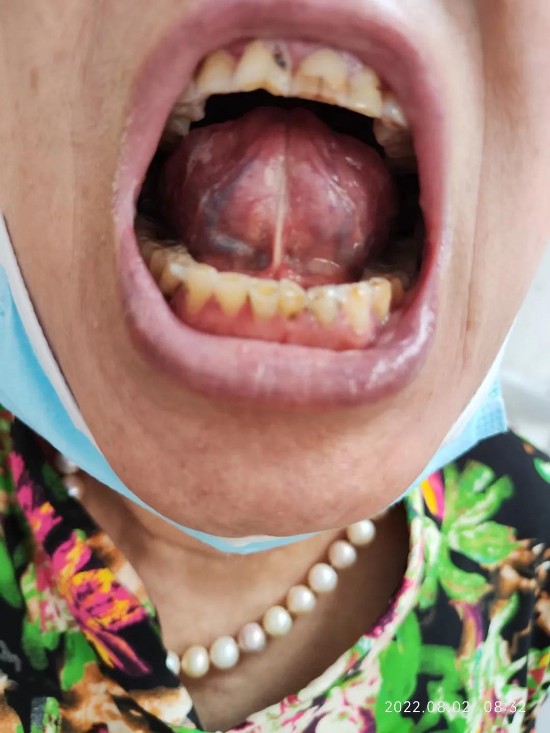 干燥综合征吃中药多久可以控制,干燥综合征喝中药可以治愈吗