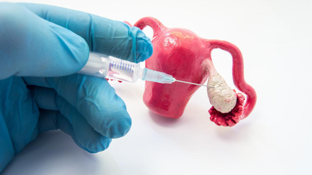 卵巢早衰和内分泌失调的关系,卵巢功能早衰和内分泌失调一样吗