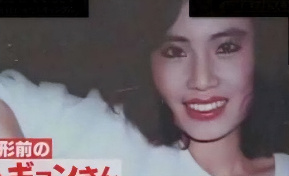 韩慧景整容是打了玻尿酸了吗,韩慧景整容案例