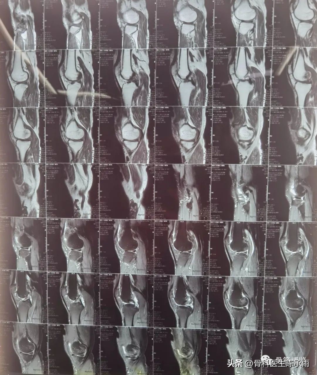 盘状半月板撕裂一级,半月板层裂愈合概率