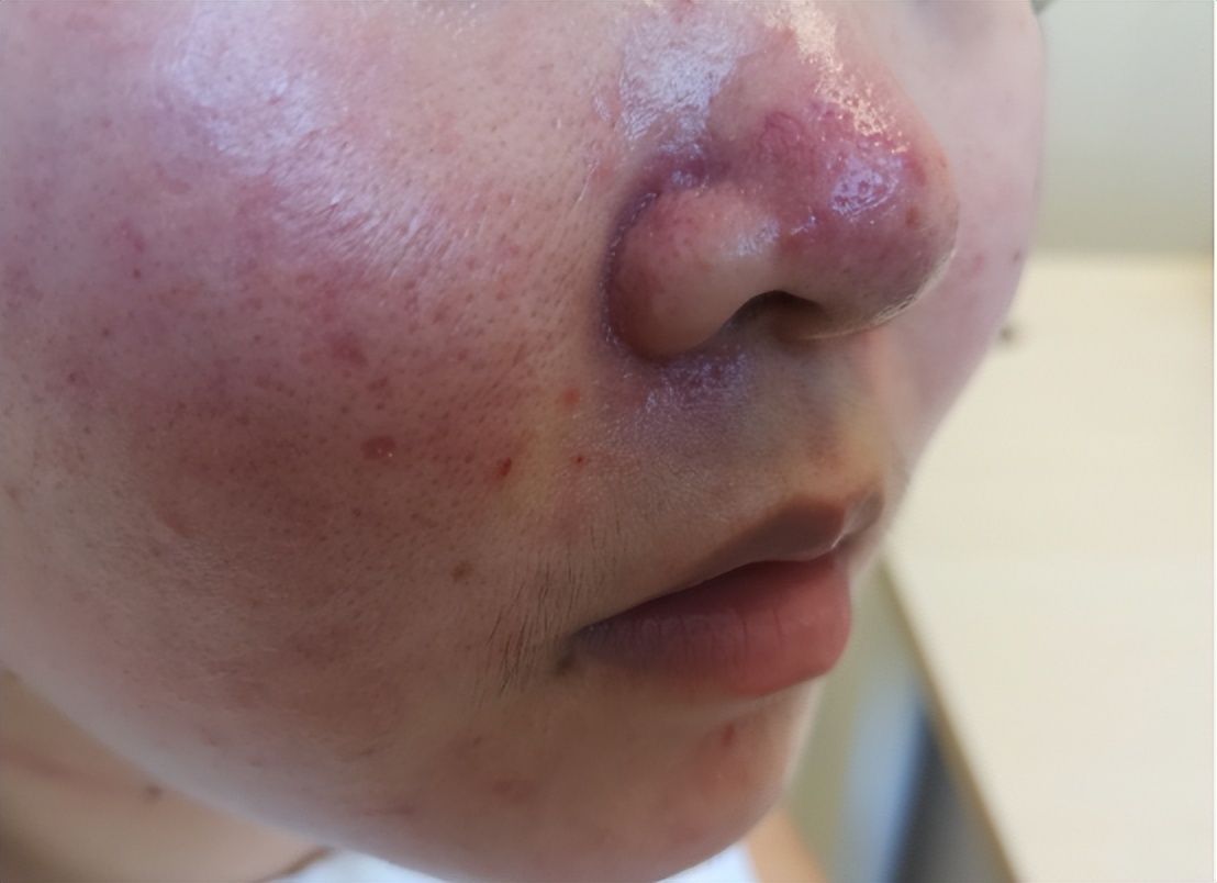 皮肤刷酸灼伤怎么办,脸上有炎症皮肤屏障受损刷酸