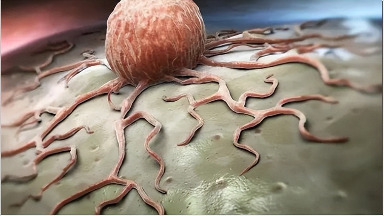 脂肪肉瘤和脂肪瘤摸着区别,脂肪瘤很常见吗