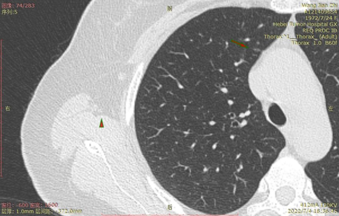 首次发现磨玻璃结节要吃药消炎吗,磨玻璃结节警惕合并占位