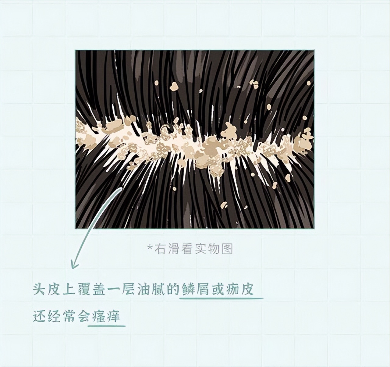 头皮内抠出白色颗粒状东西是什么,头皮上白色的小颗粒可以抠下来