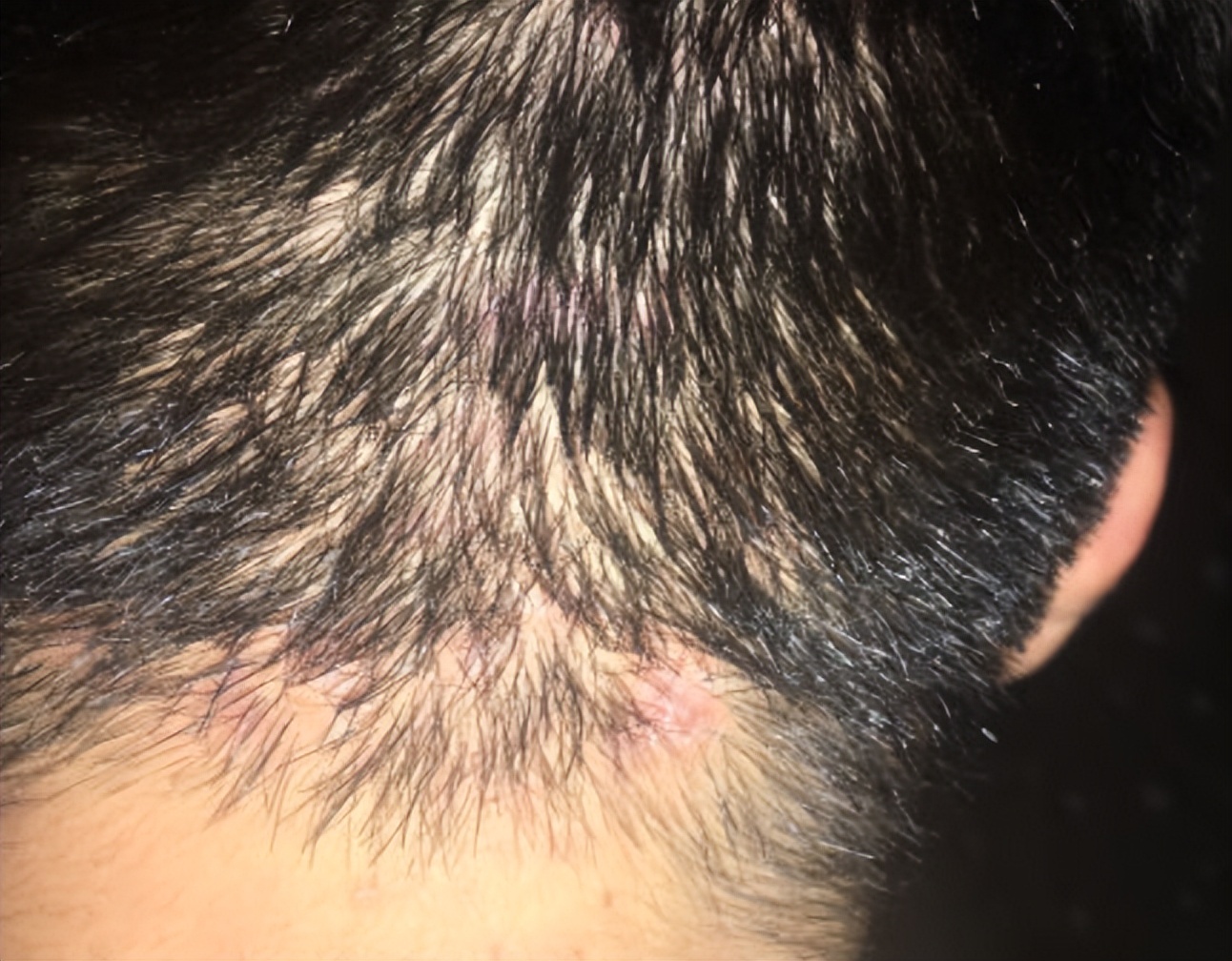 头皮痒抠出白泥是怎么回事,头皮抠出白泥头皮瘙痒如何治疗