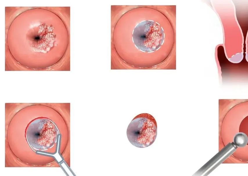 别羞羞，谁一辈子还没得过宫颈炎呢？又该怎么预防呢？