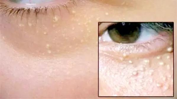 鼻头上的脂肪粒怎么挤都挤不完,脂肪粒挤还是不挤