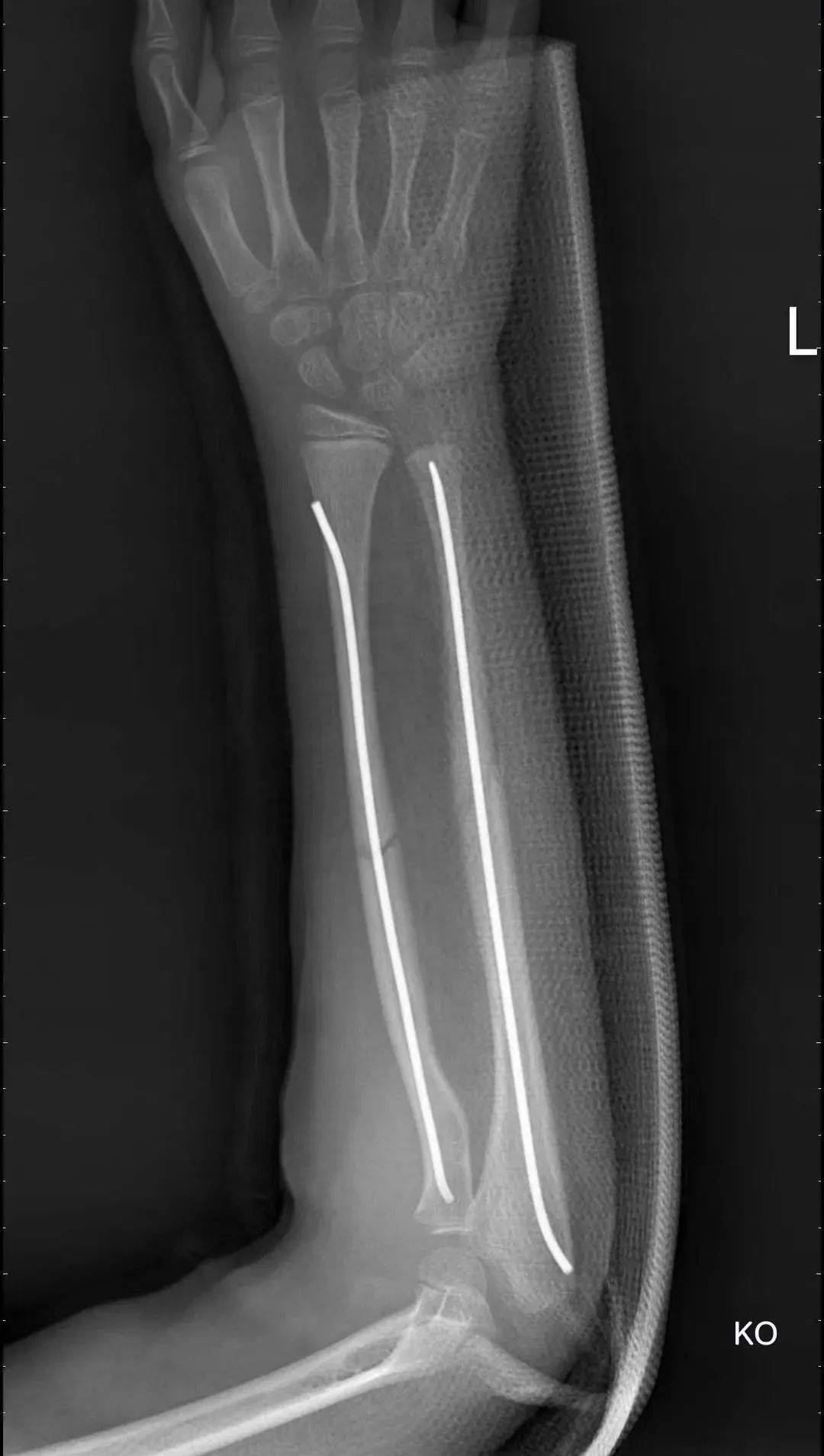 中医怎么处理小儿桡骨骨头骨折,治疗尺桡骨骨折的方法及步骤