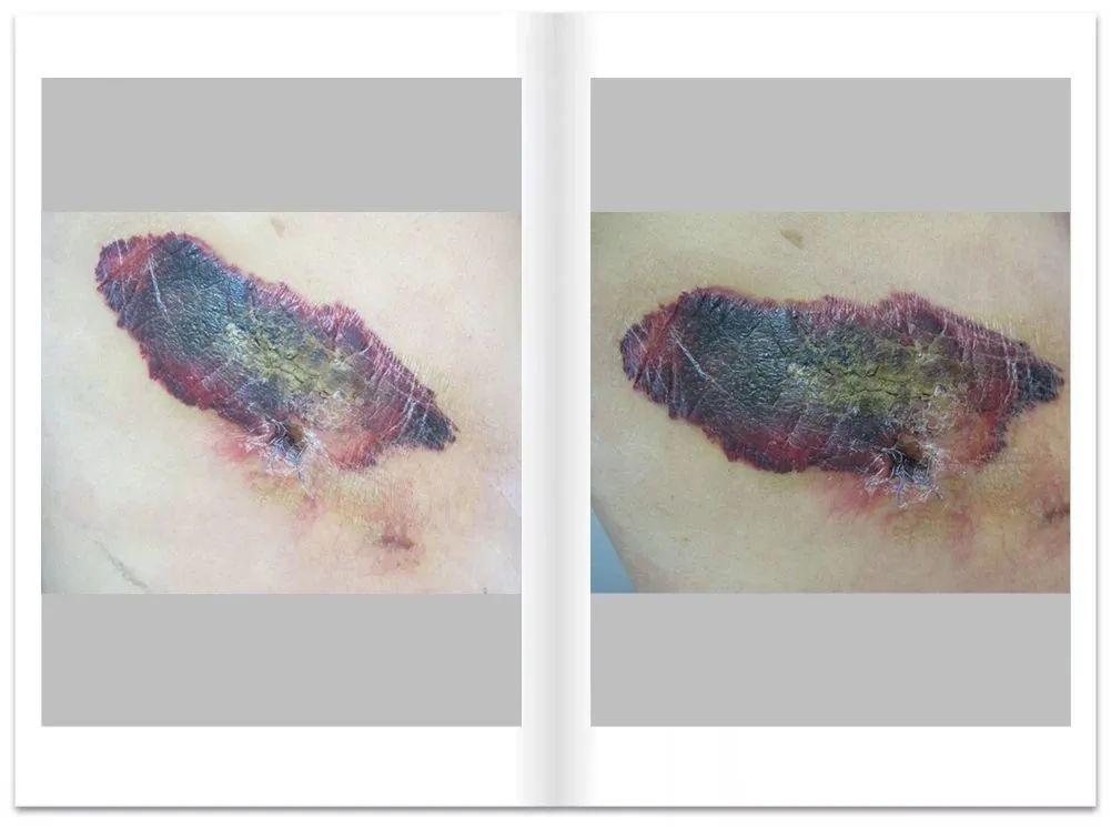 11岁男童额头上长满小疙瘩,10岁男孩子额头长斑