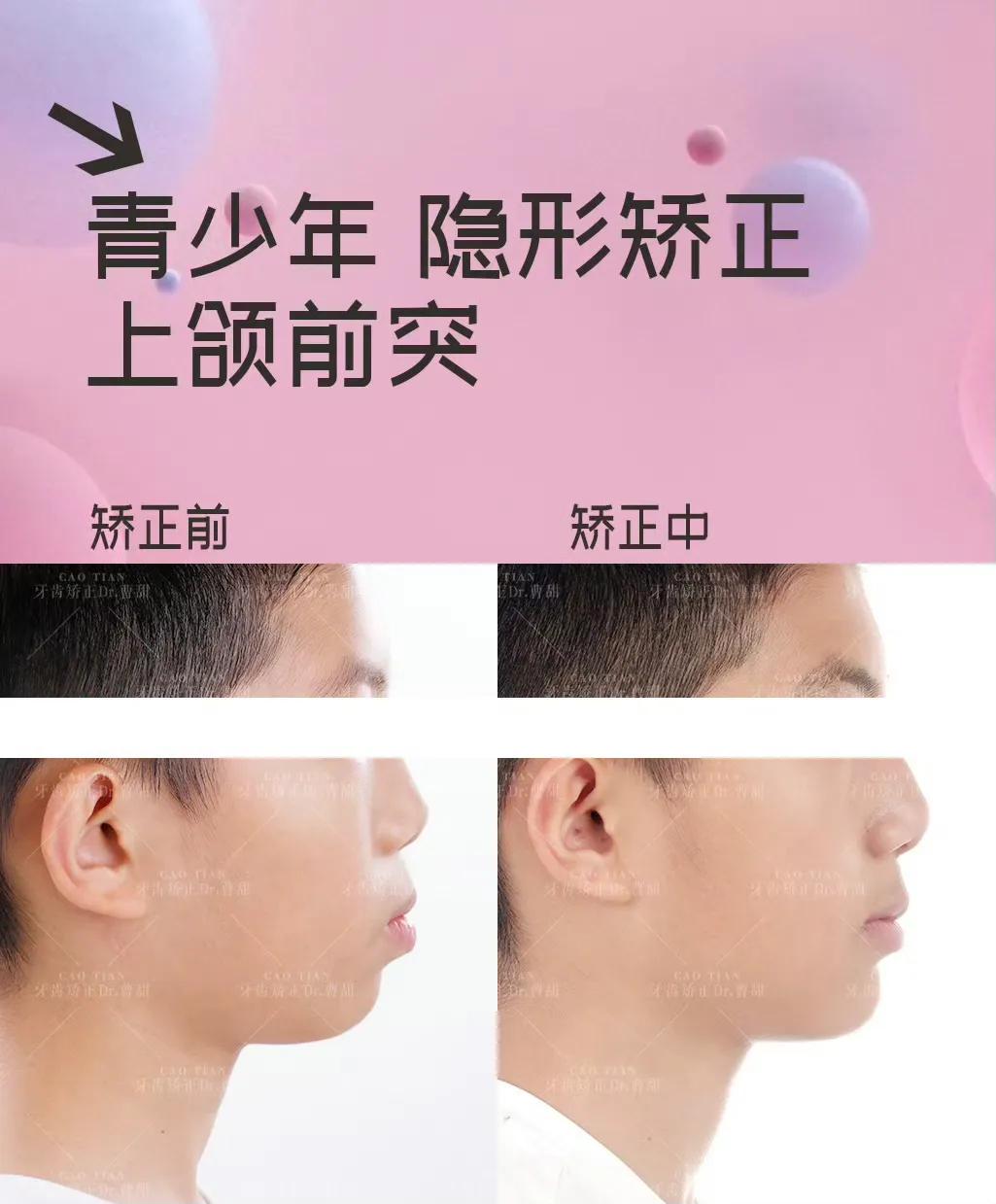 隐适美牙套脸型变化,戴隐适美牙套