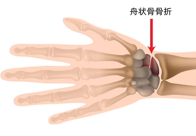 手指骨折和脚踝骨折哪个难受,手腕骨折和脚踝骨折哪个严重