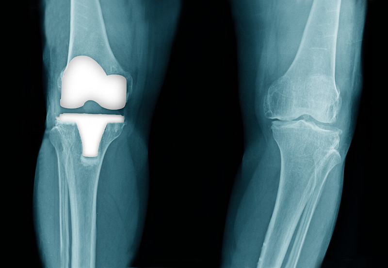 换了人工膝关节很痛苦是吗,人工膝关节换后十五年后怎么办