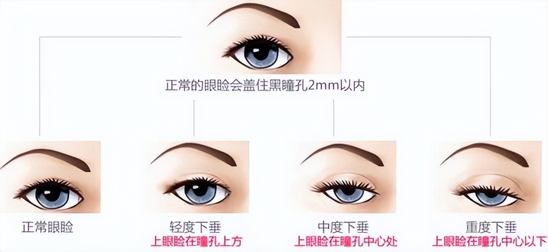 单眼上睑下垂恢复图,上眼睑下垂修复完大小眼明显
