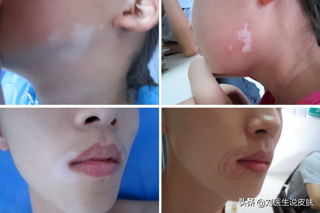 白癜风不扩散的白斑是白癜风吗,确诊白癜风出现白斑就是白癜风吗