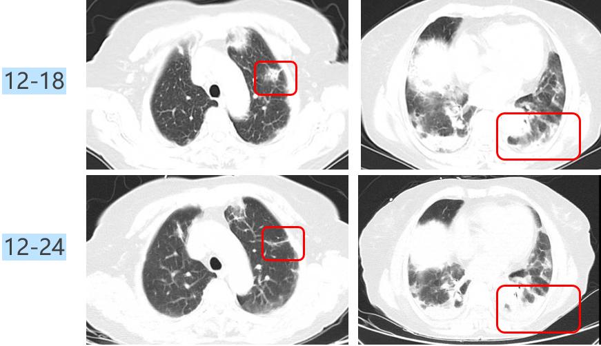 如何解读mNGS阴性结果？何时可能出现假阴性？真阴性又是为何？