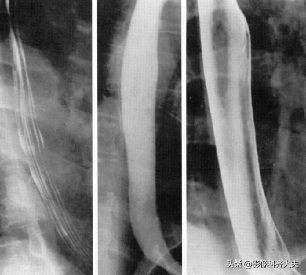胃肠道造影超声解剖图,胃肠钡餐影像检查片子