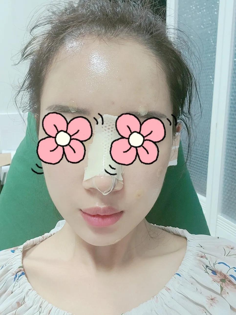 五官扁平脸怎么变高级感,扁平脸塌鼻子怎么改善