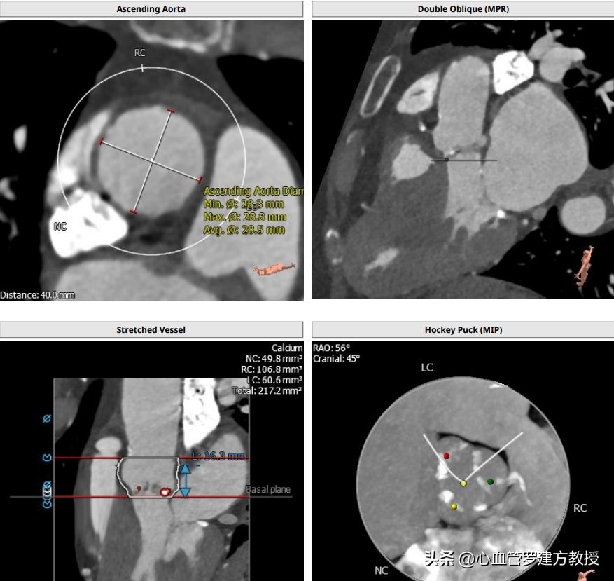 主动脉瓣狭窄的典型三联征表现,主动脉瓣狭窄治疗新技术